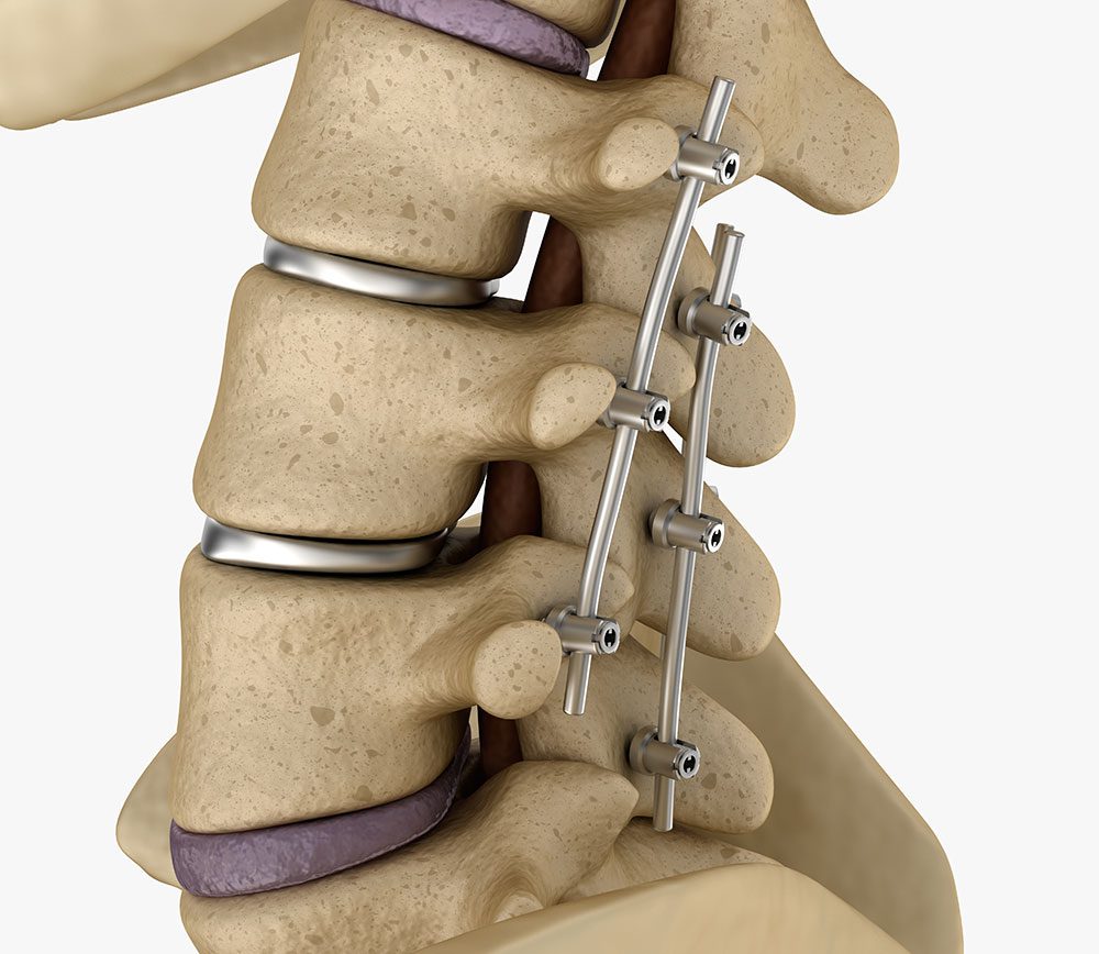 Como Funciona A Artroplastia Na Coluna A Troca De Um Disco Intervertebral Por Outro Totalmente